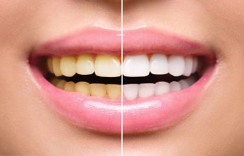 Woman Smiling Before and After Teeth Whitening Lawrenceville GA